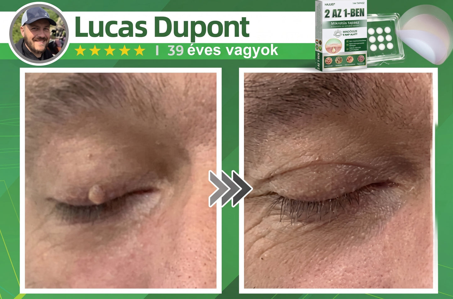 🇭🇺HAJUEI® ☺️ 2-az-1-ben Mikrotű & Hidrokoloid Tapasz | 🧪 Kiemelkedő Anyajegyek, Pattanások, Lapos Szemölcsök & Bőrkinövések Eltávolítója | Ráncok, Hegek & Bőrhibák Javítása | Láthatatlan Csillag Pattanástapasz Arcra & Testre | 144 db ✨