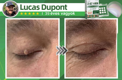 🇭🇺HAJUEI® ☺️ 2-az-1-ben Mikrotű & Hidrokoloid Tapasz | 🧪 Kiemelkedő Anyajegyek, Pattanások, Lapos Szemölcsök & Bőrkinövések Eltávolítója | Ráncok, Hegek & Bőrhibák Javítása | Láthatatlan Csillag Pattanástapasz Arcra & Testre | 144 db ✨