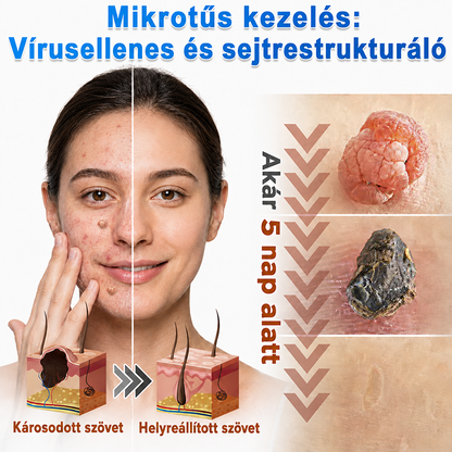 🇭🇺HAJUEI® ☺️ 2-az-1-ben Mikrotű & Hidrokoloid Tapasz | 🧪 Kiemelkedő Anyajegyek, Pattanások, Lapos Szemölcsök & Bőrkinövések Eltávolítója | Ráncok, Hegek & Bőrhibák Javítása | Láthatatlan Csillag Pattanástapasz Arcra & Testre | 144 db ✨