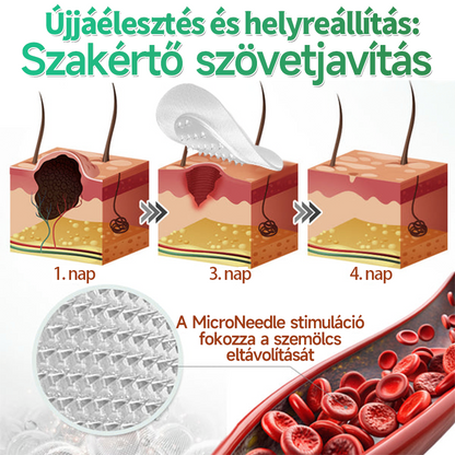 🇭🇺HAJUEI® ☺️ 2-az-1-ben Mikrotű & Hidrokoloid Tapasz | 🧪 Kiemelkedő Anyajegyek, Pattanások, Lapos Szemölcsök & Bőrkinövések Eltávolítója | Ráncok, Hegek & Bőrhibák Javítása | Láthatatlan Csillag Pattanástapasz Arcra & Testre | 144 db ✨