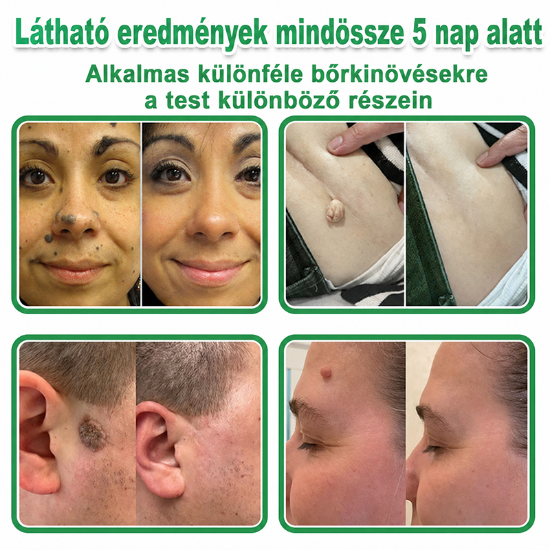🇭🇺HAJUEI® ☺️ 2-az-1-ben Mikrotű & Hidrokoloid Tapasz | 🧪 Kiemelkedő Anyajegyek, Pattanások, Lapos Szemölcsök & Bőrkinövések Eltávolítója | Ráncok, Hegek & Bőrhibák Javítása | Láthatatlan Csillag Pattanástapasz Arcra & Testre | 144 db ✨