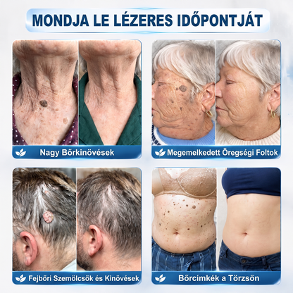 🔥Hivatalos Márkabolt | 🚢🚢 Hiskin® 7 napos Szemölcseltávolító Roll-on Ápoló Folyadék (Fájdalommentes rollerball technológia, hegek nélkül) 🐬