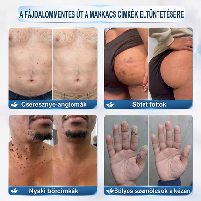 ✅Hivatalos Márkabolt | 🚢🚢 Hiskin® 7 napos Szemölcseltávolító Roll-on Ápoló Folyadék (Fájdalommentes rollerball technológia, hegek nélkül) 🐬