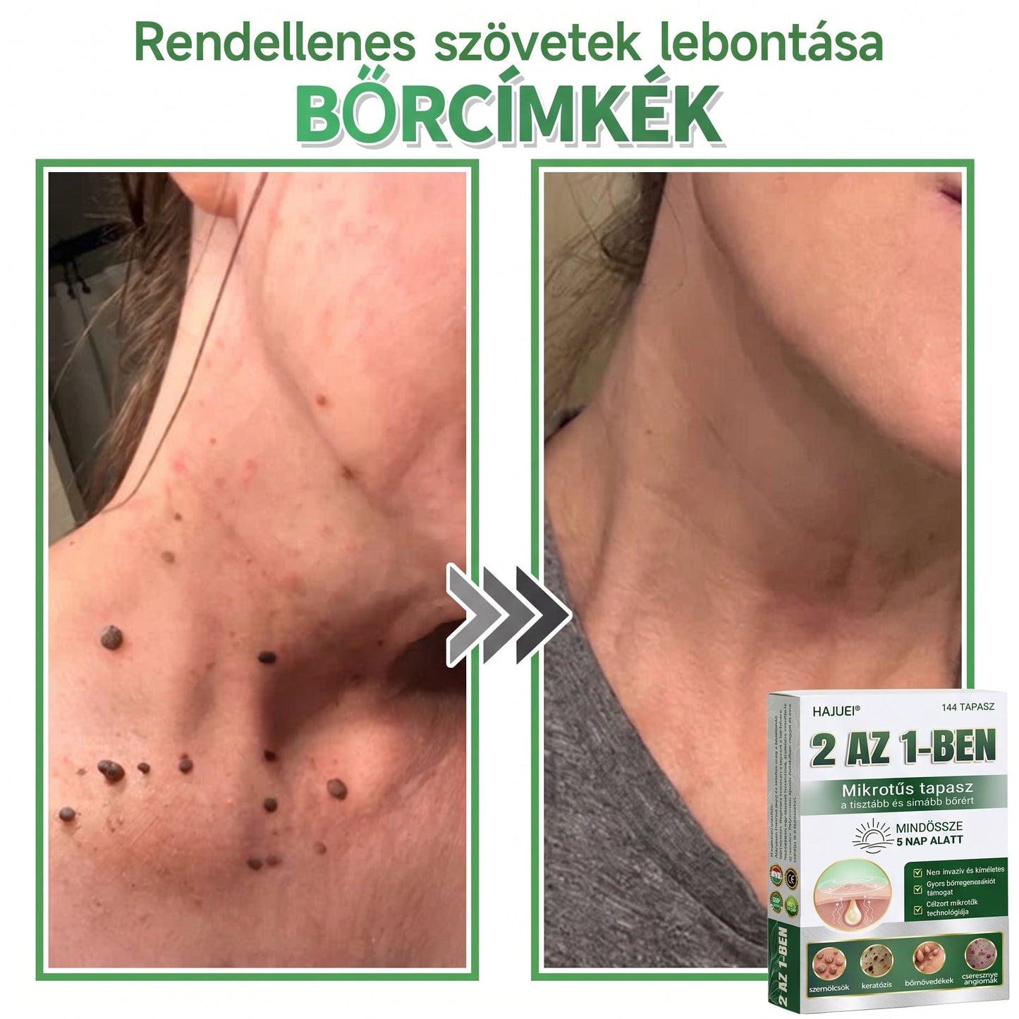 🇭🇺HAJUEI® ☺️ 2-az-1-ben Mikrotű & Hidrokoloid Tapasz | 🧪 Kiemelkedő Anyajegyek, Pattanások, Lapos Szemölcsök & Bőrkinövések Eltávolítója | Ráncok, Hegek & Bőrhibák Javítása | Láthatatlan Csillag Pattanástapasz Arcra & Testre | 144 db ✨