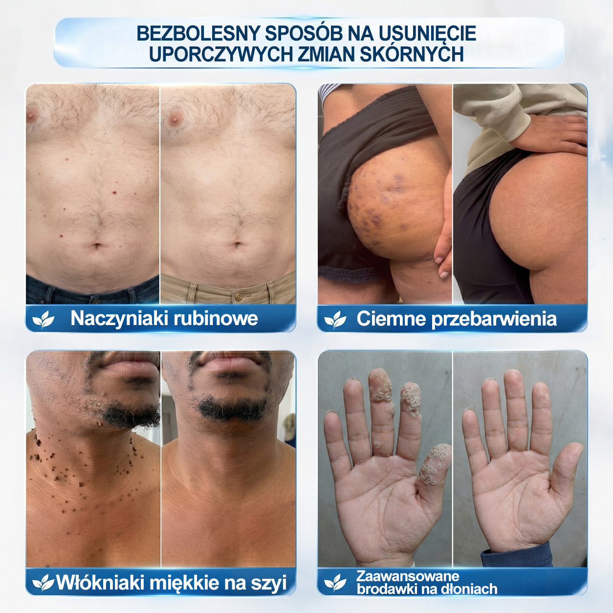 🍀🍀🍀Hiskin® 7 𝑫𝒏𝒊 𝑷𝒓𝒆𝒑𝒂𝒓𝒂𝒕 𝑫𝒐 𝑼𝒔𝒖𝒘𝒂𝒏𝒊𝒂 𝑾łó𝒌𝒏𝒊𝒂𝒌ó𝒘 𝑴𝒊ę𝒌𝒌𝒊𝒄𝒉 𝑰 𝑷𝒓𝒛𝒆𝒃𝒂𝒓𝒘𝒊𝒆ń(𝐁𝐞𝐳 𝐁ó𝐥𝐮, 𝐁𝐞𝐳 𝐁𝐥𝐢𝐳𝐧 – 𝐑𝐨𝐥𝐥-𝐨𝐧)