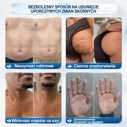 🍀🍀🍀Hiskin® 7 𝑫𝒏𝒊 𝑷𝒓𝒆𝒑𝒂𝒓𝒂𝒕 𝑫𝒐 𝑼𝒔𝒖𝒘𝒂𝒏𝒊𝒂 𝑾łó𝒌𝒏𝒊𝒂𝒌ó𝒘 𝑴𝒊ę𝒌𝒌𝒊𝒄𝒉 𝑰 𝑷𝒓𝒛𝒆𝒃𝒂𝒓𝒘𝒊𝒆ń(𝐁𝐞𝐳 𝐁ó𝐥𝐮, 𝐁𝐞𝐳 𝐁𝐥𝐢𝐳𝐧 – 𝐑𝐨𝐥𝐥-𝐨𝐧)