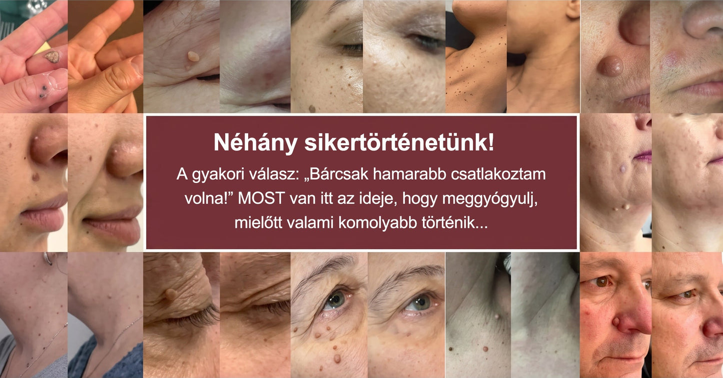 ✨PURESHADE® 2 az 1-ben mikrotűs és hidrokolloid tapasz🍀 | Kiálló anyajegyek, aknék, lapos szemölcsök és bőrnövedékek eltávolítására | Segít csökkenteni a ráncokat, hegeket és bőrhibákat | Láthatatlan tapasz az arcra és testre