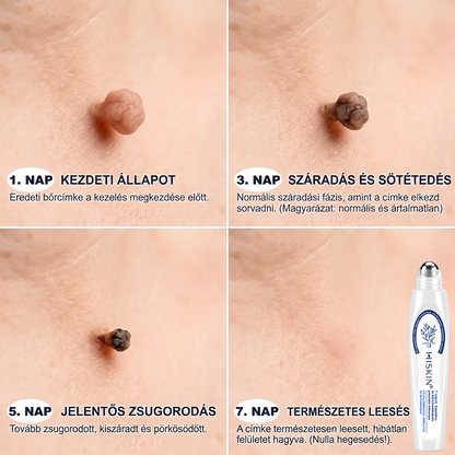 💎Hivatalos Márkabolt | 🚢🚢 Hiskin® 7 napos Szemölcseltávolító Roll-on Ápoló Folyadék (Fájdalommentes rollerball technológia, hegek nélkül) 🐬