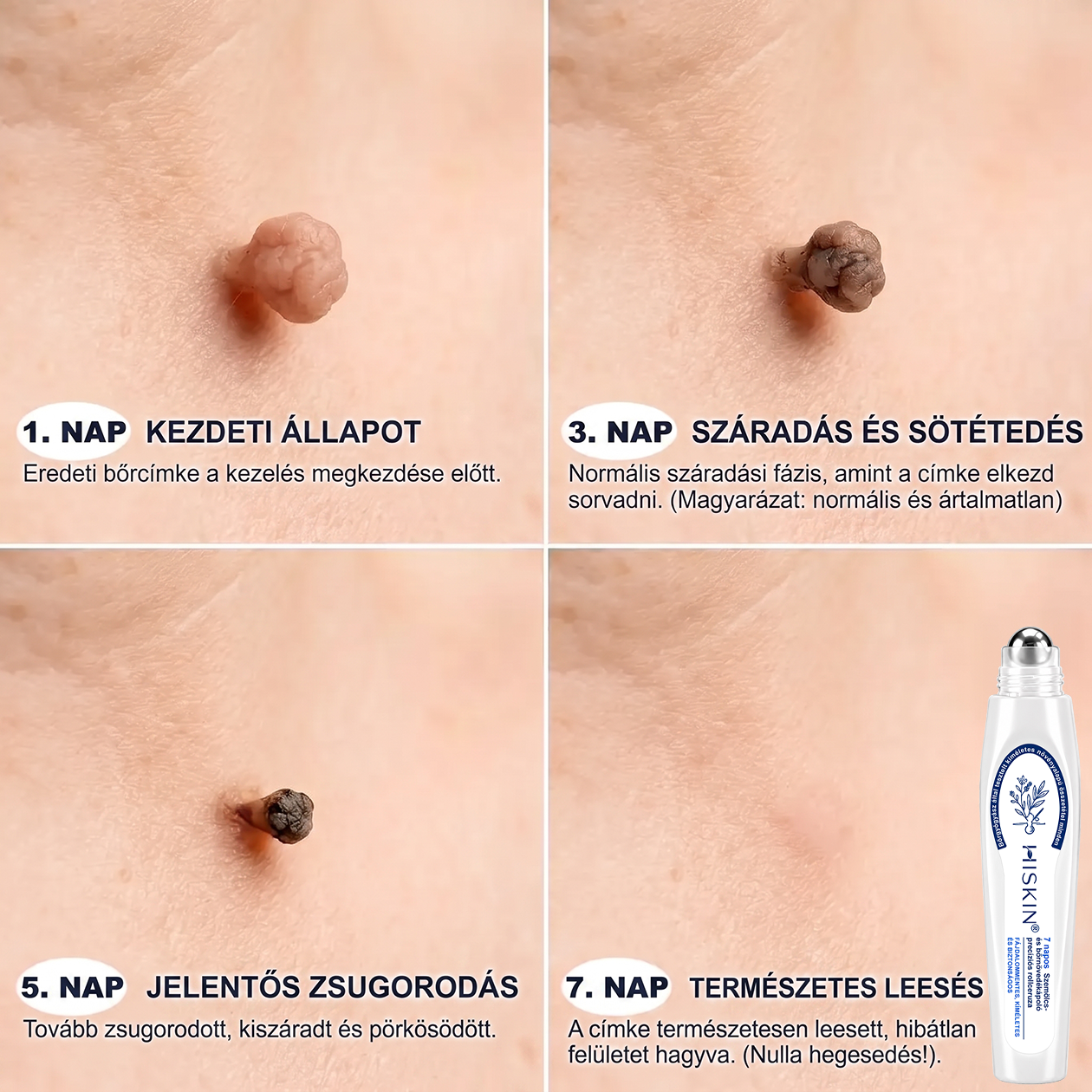 🔥Hivatalos Márkabolt | 🚢🚢 Hiskin® 7 napos Szemölcseltávolító Roll-on Ápoló Folyadék (Fájdalommentes rollerball technológia, hegek nélkül) 🐬