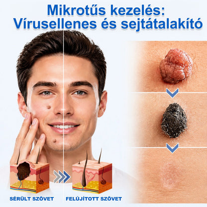 ✨PURESHADE® 2 az 1-ben mikrotűs és hidrokolloid tapasz🍀 | Kiálló anyajegyek, aknék, lapos szemölcsök és bőrnövedékek eltávolítására | Segít csökkenteni a ráncokat, hegeket és bőrhibákat | Láthatatlan tapasz az arcra és testre