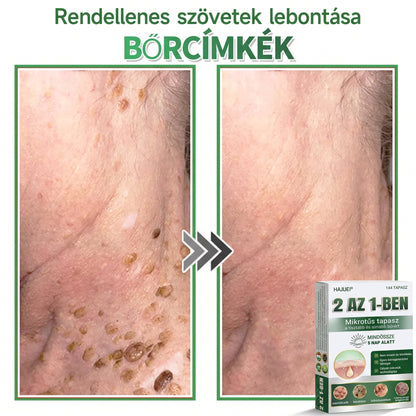 🇭🇺HAJUEI® ☺️ 2-az-1-ben Mikrotű & Hidrokoloid Tapasz | 🧪 Kiemelkedő Anyajegyek, Pattanások, Lapos Szemölcsök & Bőrkinövések Eltávolítója | Ráncok, Hegek & Bőrhibák Javítása | Láthatatlan Csillag Pattanástapasz Arcra & Testre | 144 db ✨