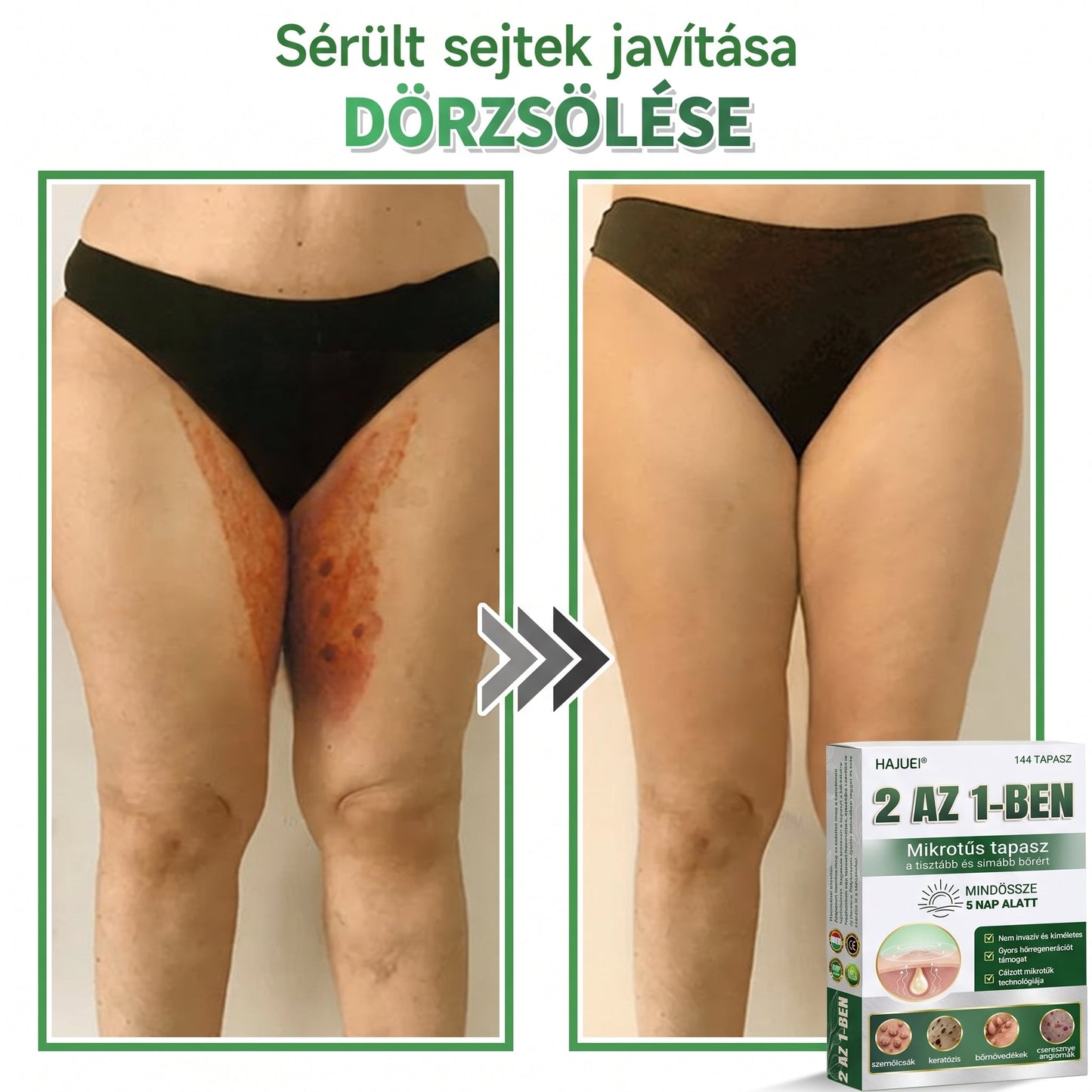 🇭🇺HAJUEI® ☺️ 2-az-1-ben Mikrotű & Hidrokoloid Tapasz | 🧪 Kiemelkedő Anyajegyek, Pattanások, Lapos Szemölcsök & Bőrkinövések Eltávolítója | Ráncok, Hegek & Bőrhibák Javítása | Láthatatlan Csillag Pattanástapasz Arcra & Testre | 144 db ✨
