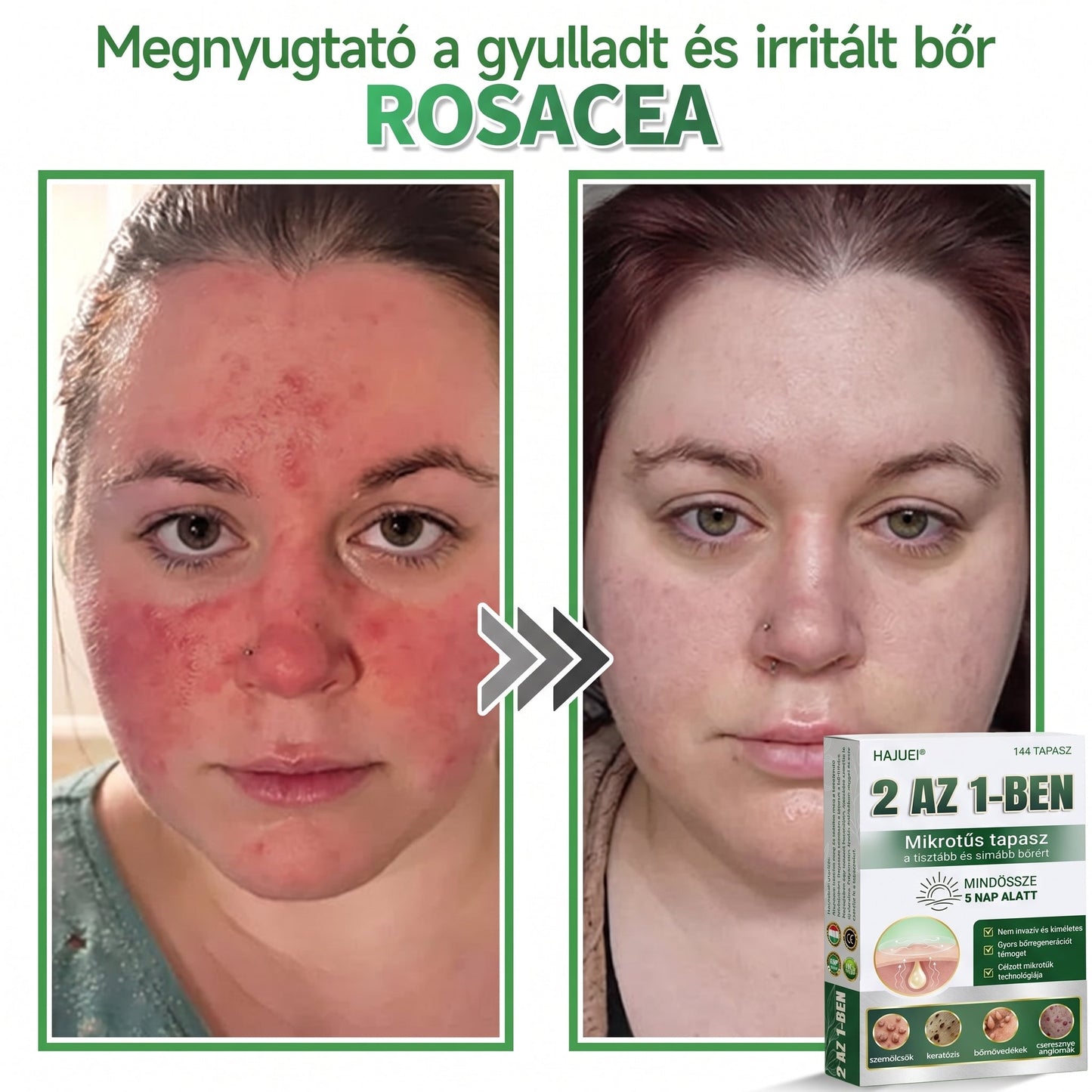 🇭🇺HAJUEI® ☺️ 2-az-1-ben Mikrotű & Hidrokoloid Tapasz | 🧪 Kiemelkedő Anyajegyek, Pattanások, Lapos Szemölcsök & Bőrkinövések Eltávolítója | Ráncok, Hegek & Bőrhibák Javítása | Láthatatlan Csillag Pattanástapasz Arcra & Testre | 144 db ✨