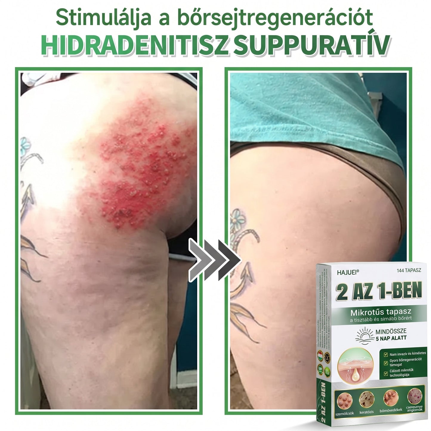 🇭🇺HAJUEI® ☺️ 2-az-1-ben Mikrotű & Hidrokoloid Tapasz | 🧪 Kiemelkedő Anyajegyek, Pattanások, Lapos Szemölcsök & Bőrkinövések Eltávolítója | Ráncok, Hegek & Bőrhibák Javítása | Láthatatlan Csillag Pattanástapasz Arcra & Testre | 144 db ✨